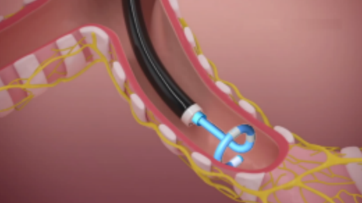堃博醫療肺部靶向去神經射頻消融能量係統完成首例臨床應用